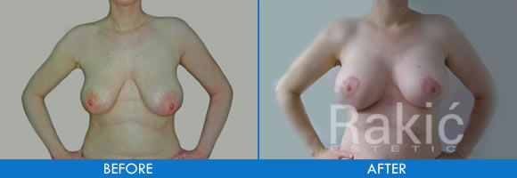 Breast reduction and breast lift